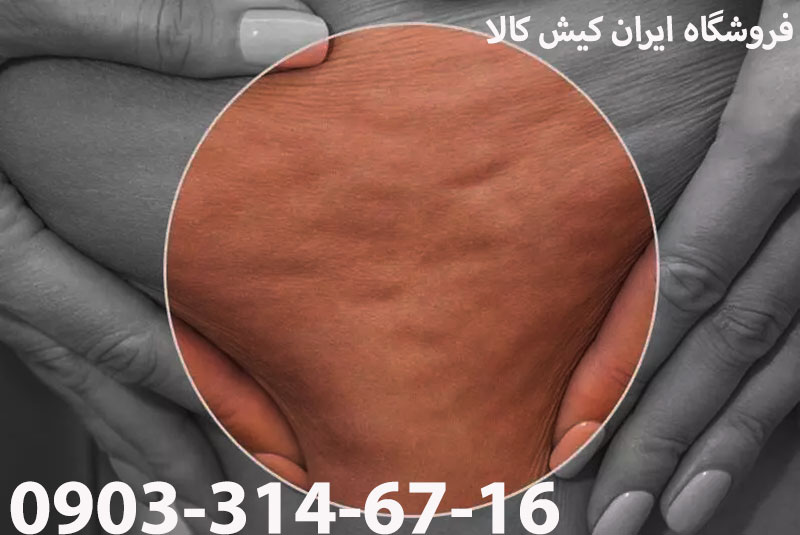 قیمت بهترین کرم آنتی سلولیت و ژل لاغری سلولیت