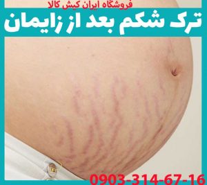 ترک شکم بعد زایمان